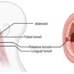 Adenoidid in Children: Causes, Risks, and Diagnosis
