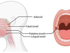 Adenoidid in Children: Causes, Risks, and Diagnosis