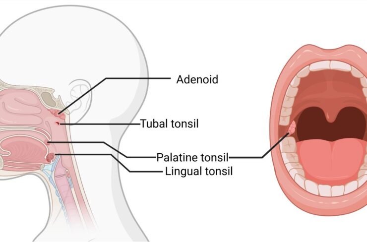 Adenoidid in Children: Causes, Risks, and Diagnosis